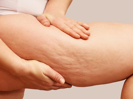 Cellulite: What, Why, How?