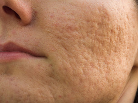 Acne Scarring: What, Why, How?