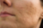 Acne Scarring | A photo of a woman with rolling acne scars on her cheek