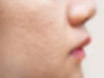 Acne Scarring | A photo of ice-pick acne scars on a woman's cheek