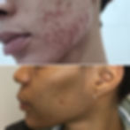 Acne Scarring | A before and after of an acne scarring treatment programme.