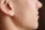 Acne Scarring | A photo of boxcar acne scars on a man's cheek