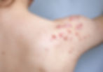 Acne Scarring | A photo of keloid acne scarring on the back of the shoulder